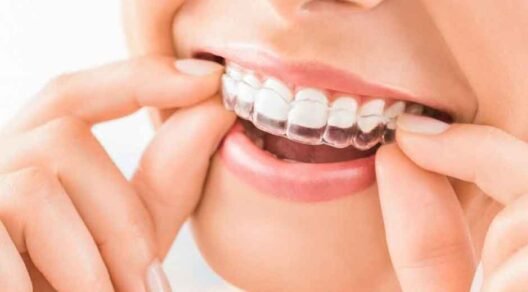 Is-Invisalign-Only-for-Minor-Teeth-Adjustments