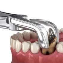 Myths About Teeth Extraction: What You Need To Know
