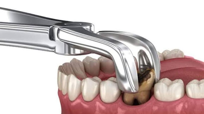 Myths About Teeth Extraction: What You Need To Know
