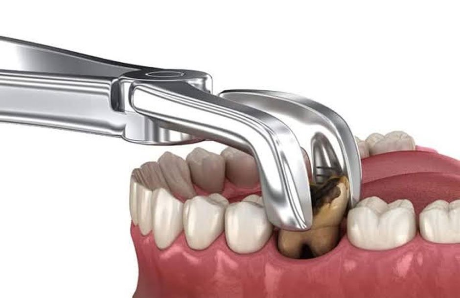 Myths About Teeth Extraction: What You Need To Know