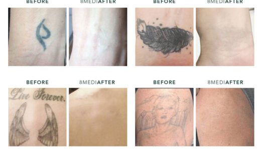 Top 10 Tattoo Removal Tips for Faster Fading and Better Results