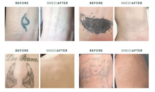 Top 10 Tattoo Removal Tips for Faster Fading and Better Results