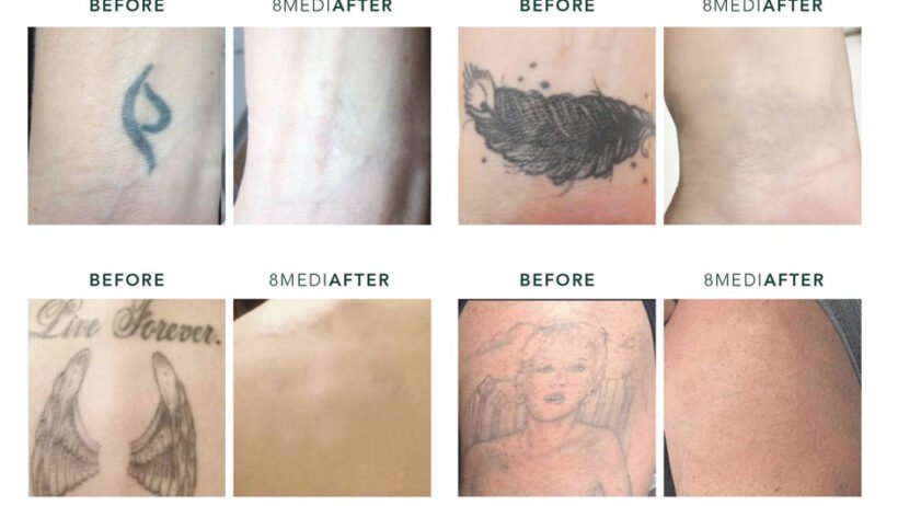 Top 10 Tattoo Removal Tips for Faster Fading and Better Results