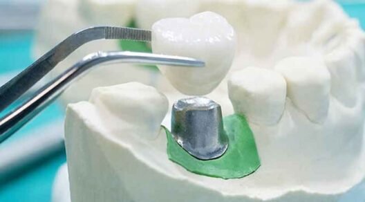 An Overview of the Major Types of Restorative Dentistry in Sugar Land
