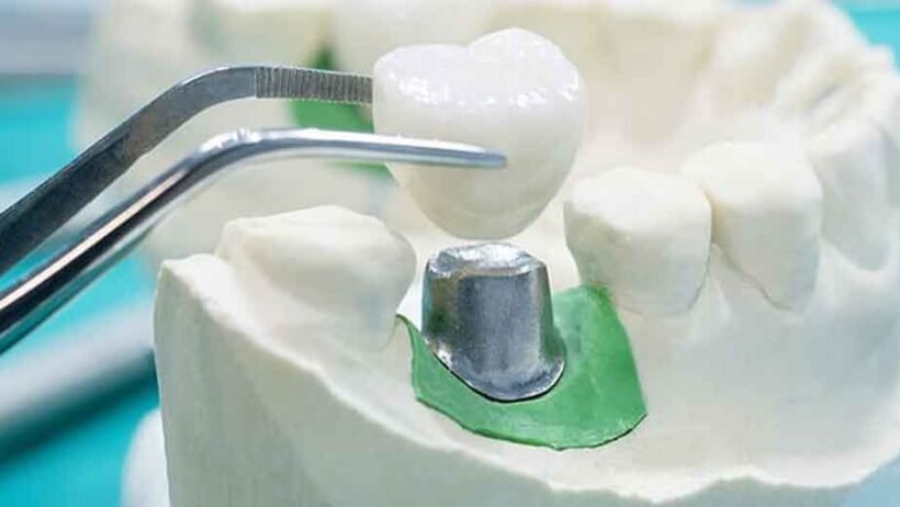 An Overview of the Major Types of Restorative Dentistry in Sugar Land