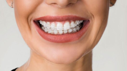 Clear Braces Rise in Demand as Kelowna Embraces Discreet Dental Innovation