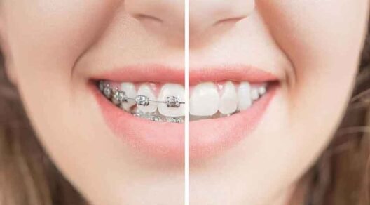 Why Ceramic Braces Are a Top Choice for Adults in Johns Creek