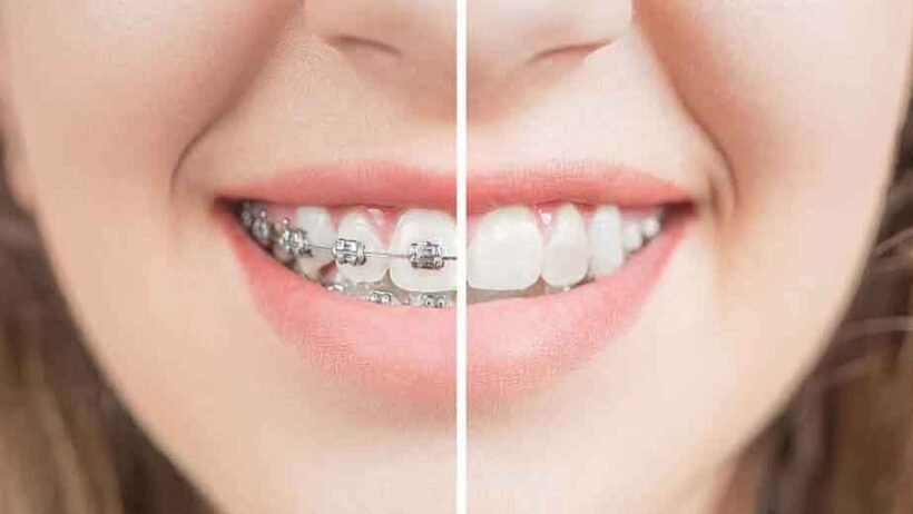 Why Ceramic Braces Are a Top Choice for Adults in Johns Creek
