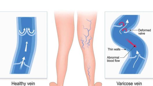 Find Out When You Really Need a Doctor for Varicose Veins