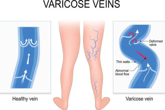 Find Out When You Really Need a Doctor for Varicose Veins