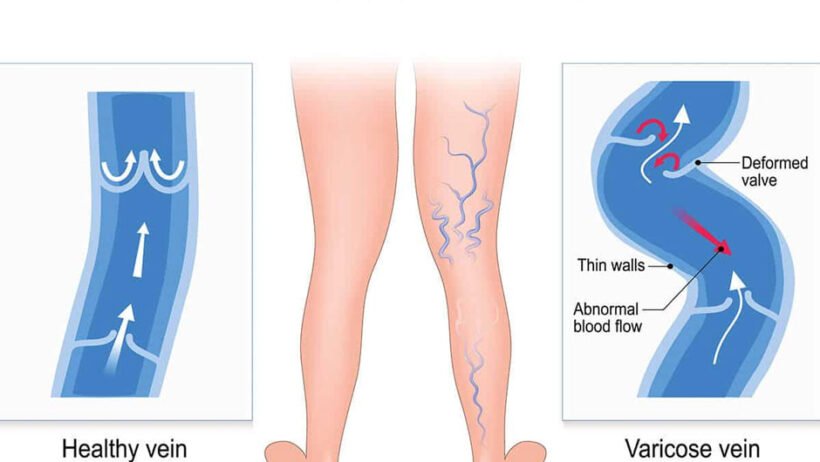 Find Out When You Really Need a Doctor for Varicose Veins