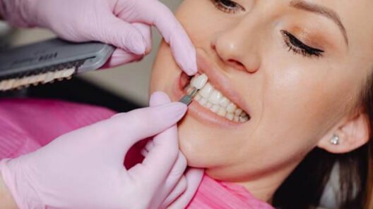 Step-by-Step Stages of Professional Veneer Treatment in Peabody