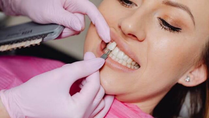Step-by-Step Stages of Professional Veneer Treatment in Peabody