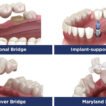 When Should You Repair a Crown or Dental Bridge in Kitchener?