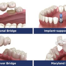 When Should You Repair a Crown or Dental Bridge in Kitchener?