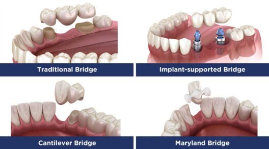 When Should You Repair a Crown or Dental Bridge in Kitchener?