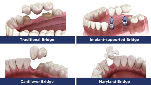 When Should You Repair a Crown or Dental Bridge in Kitchener?