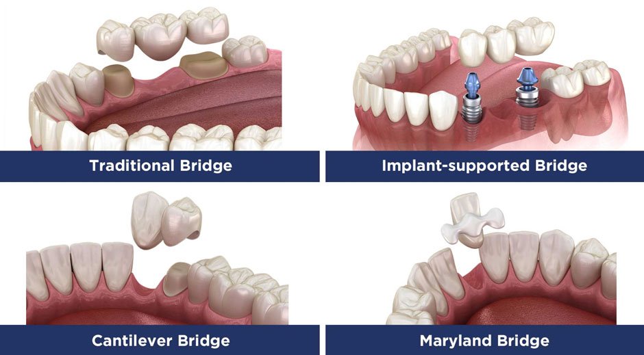 When Should You Repair a Crown or Dental Bridge in Kitchener?
