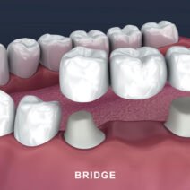 When To Consider Crowns And Bridges For Tooth Repair In Leawood