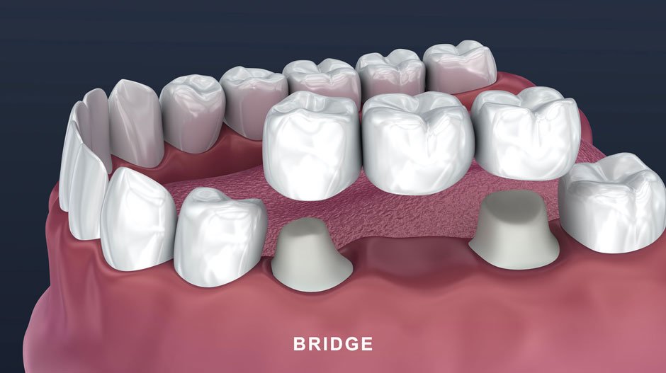 When To Consider Crowns And Bridges For Tooth Repair In Leawood